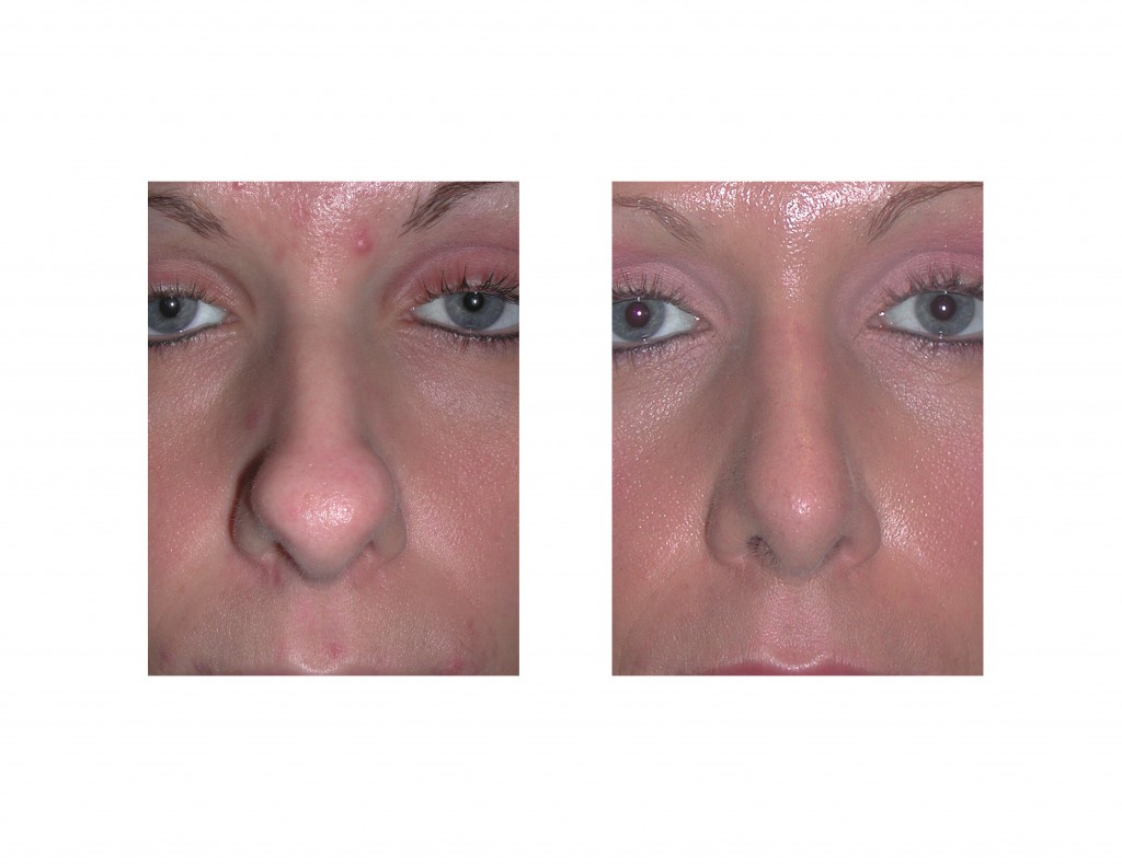 boxy nasal tip Archives