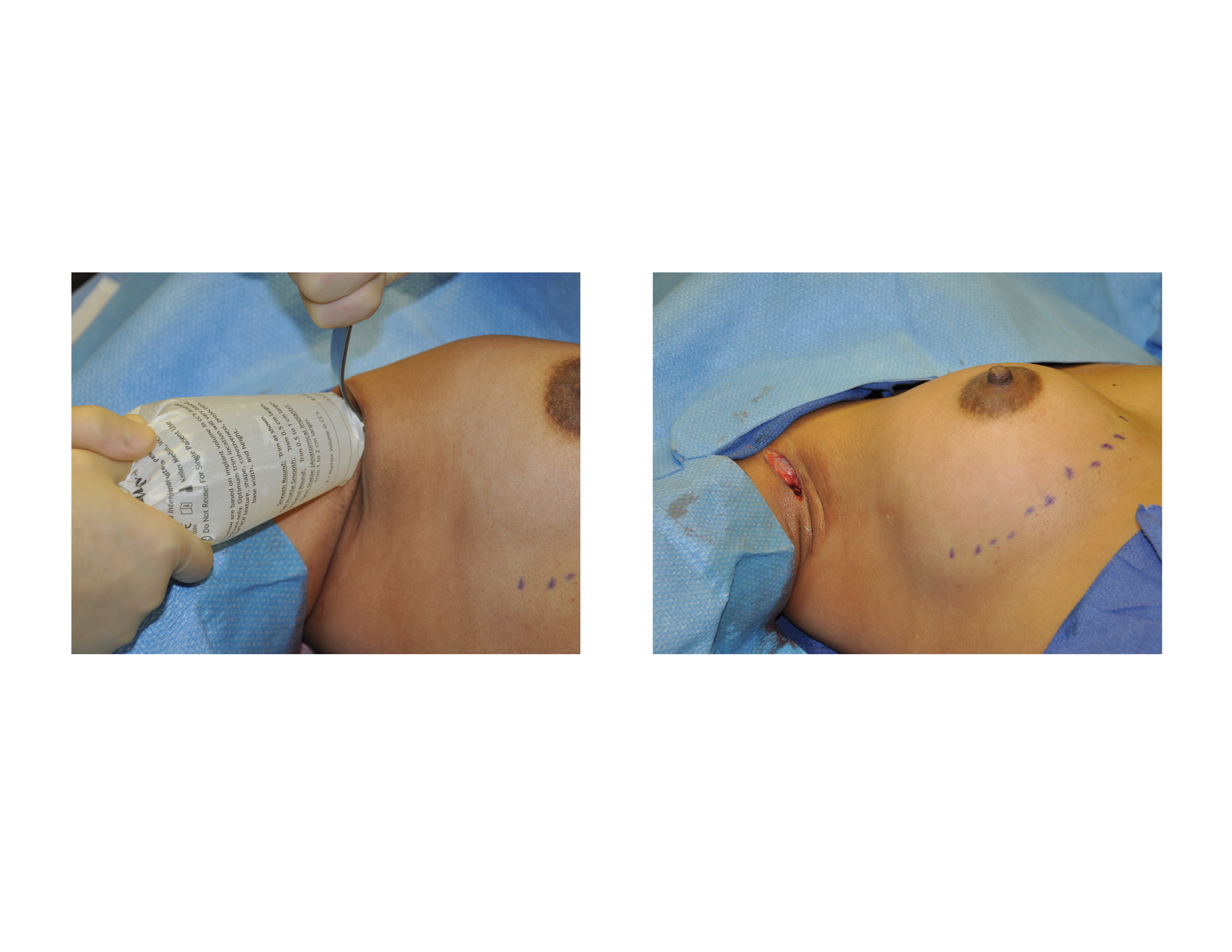 Transaxillary Funnel Breast Augmentation intraop Dr Barry Eppley