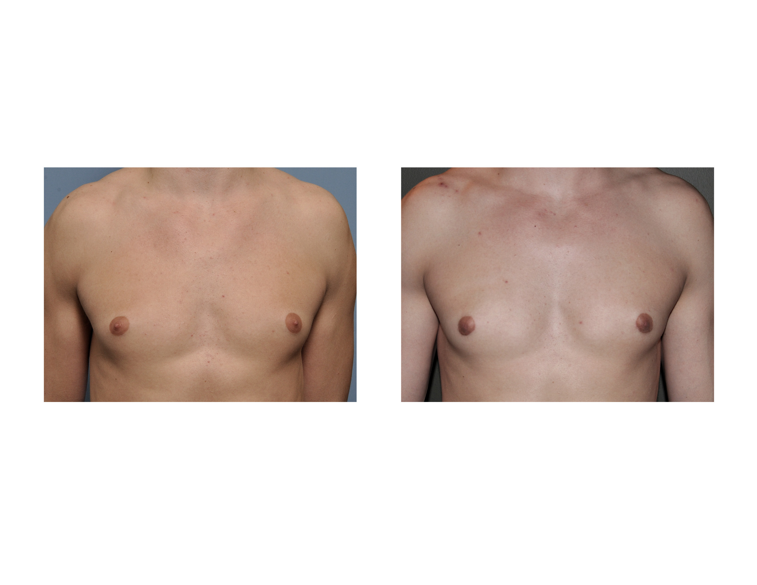 Case Study: Reduction of Puffy Nipples in Young Men - Explore