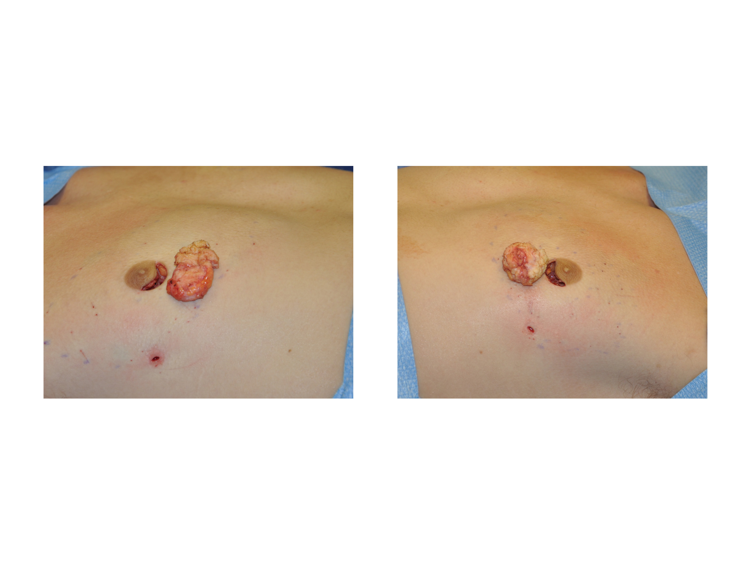 https://exploreplasticsurgery.com/wp-content/uploads/2013/06/Areolar-gynecomastia-Excision-Dr-Barry-Eppley-Indianapolis.jpg