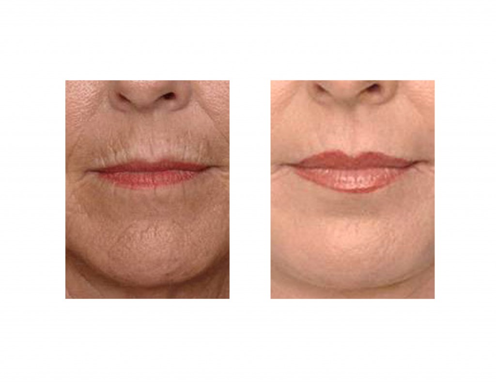 Treatment Options for Vertical Upper Lip Lines Explore Plastic Surgery