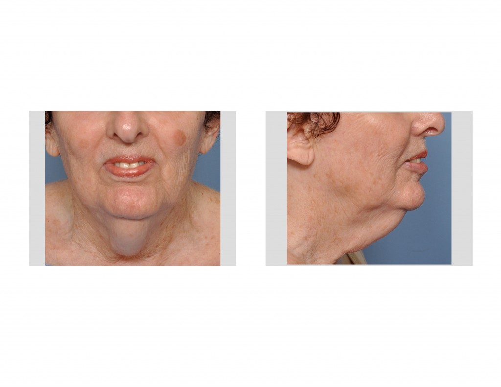 Direct Necklift In Women Archives