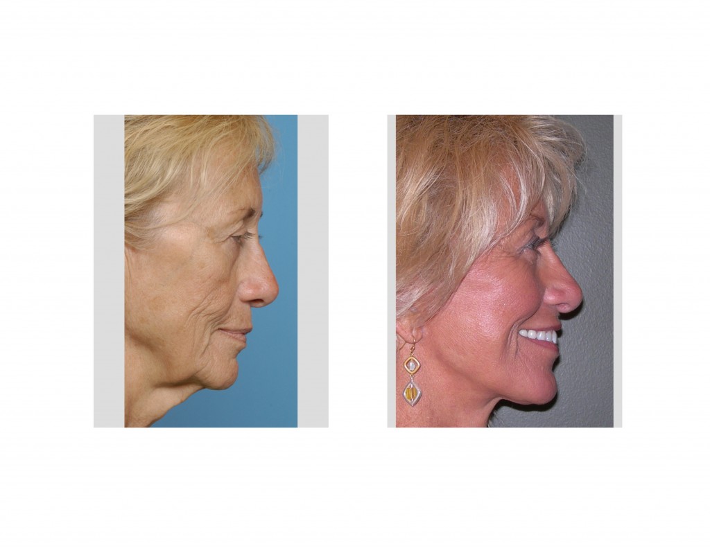 Facelifts and Age Reversal Explore Plastic Surgery