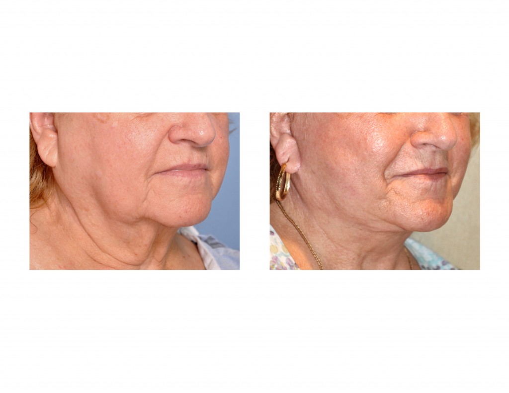 Case Study: Full Facelift for Neck Wattle Correction - Explore Plastic ...