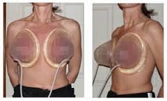 Use of the Brava Device in Fat Injection Breast Augmentation