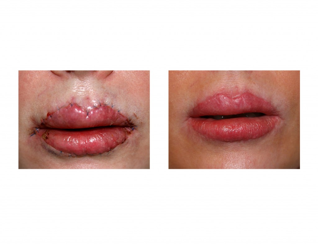 Case Study Revision of Lip (Vermilion) Advancements Explore Plastic