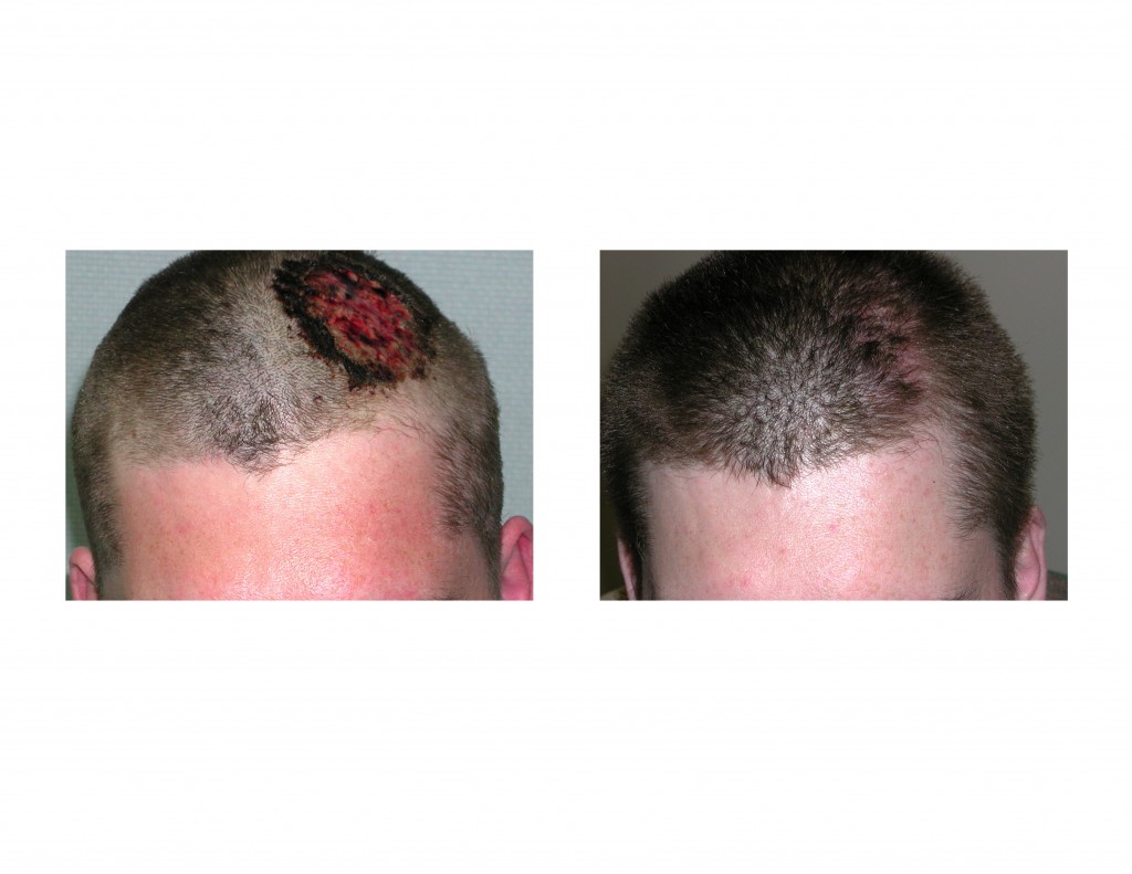 Case Study Tissue Expansion in Scalp Reconstruction Explore Plastic