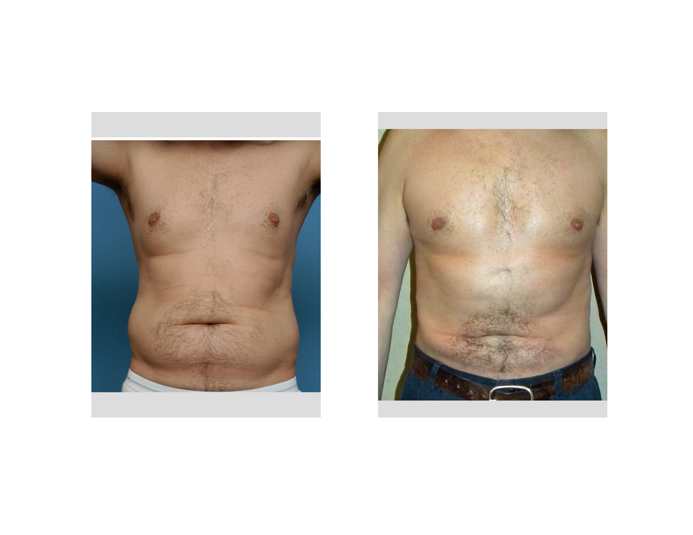 Case Study Realistic Male Abdominal And Love Handle Liposuction