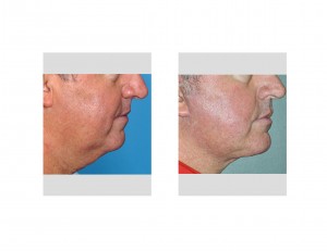Male Facelift result side view Dr Barry Eppley Indianapolis