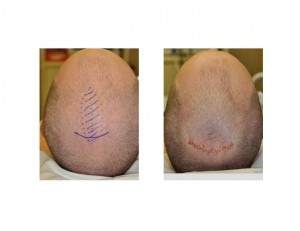 Sagittal Ridge Skull Reduction Incision and Closure Dr Barry Eppley Indianapolis
