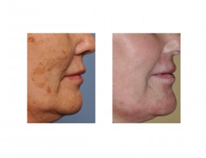 Brown Spot Laser Removal result side view Dr Barry Eppley Indianapolis