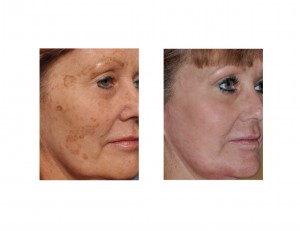 Brown Spot Laser Removal results oblique view Dr Barry Eppley Indianapolis