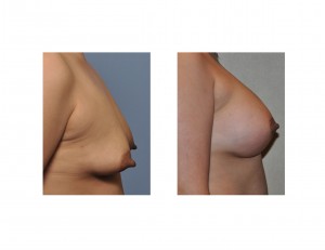 Female Nipple Reduction Dr Barry Eppley Indianapolis