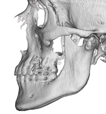 High Jaw Angles Dr Barry Eppley Indianapolis - Explore Plastic Surgery