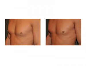 Male Nipple Reduction Surgery Results Dr Barry Eppley Indianapolis