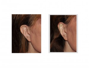 Mini Otoplasty result Dr Barry Eppley Indianapolis