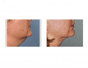 Neck Liposuction Dr Barry Eppley Indianapolis