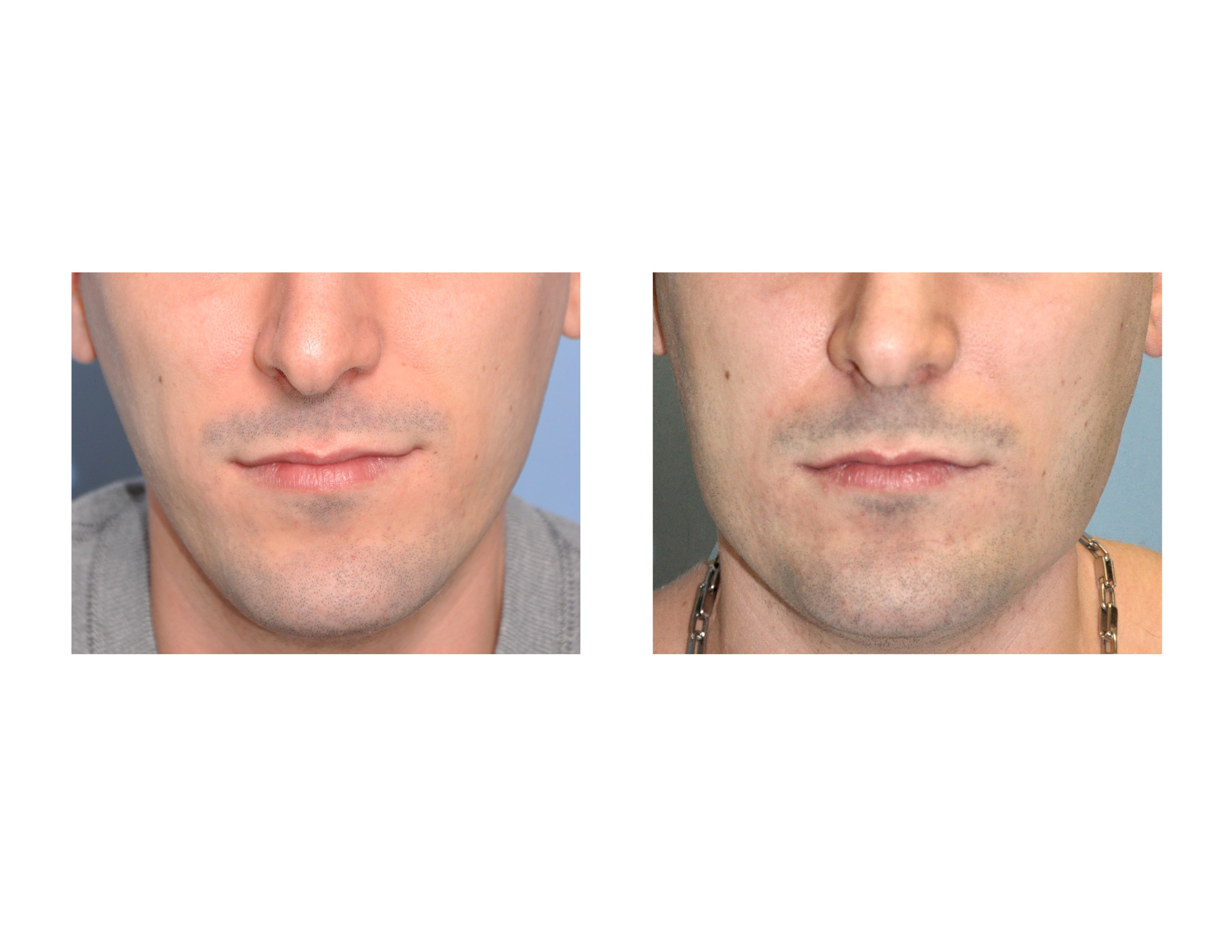 Vertical lengthening chin implant