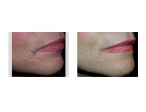 The Corner of the Mouth Lift For the Sad or Aging Mouth Correction ...