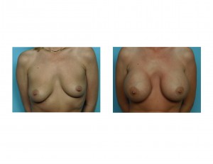 Large Breast Augmemntation result front view Dr Barry Eppley Indianapolis