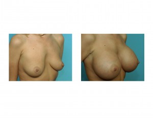 Large Breast Augmentation result oblique view Dr Barry Eppley Indianapolis