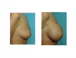 Large Breast Augmentation result side view Dr Barry Eppley Indianapolis