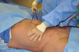 Abdominal Etching Six Pack Surgery intraop Dr Barry Eppley Indianapolis