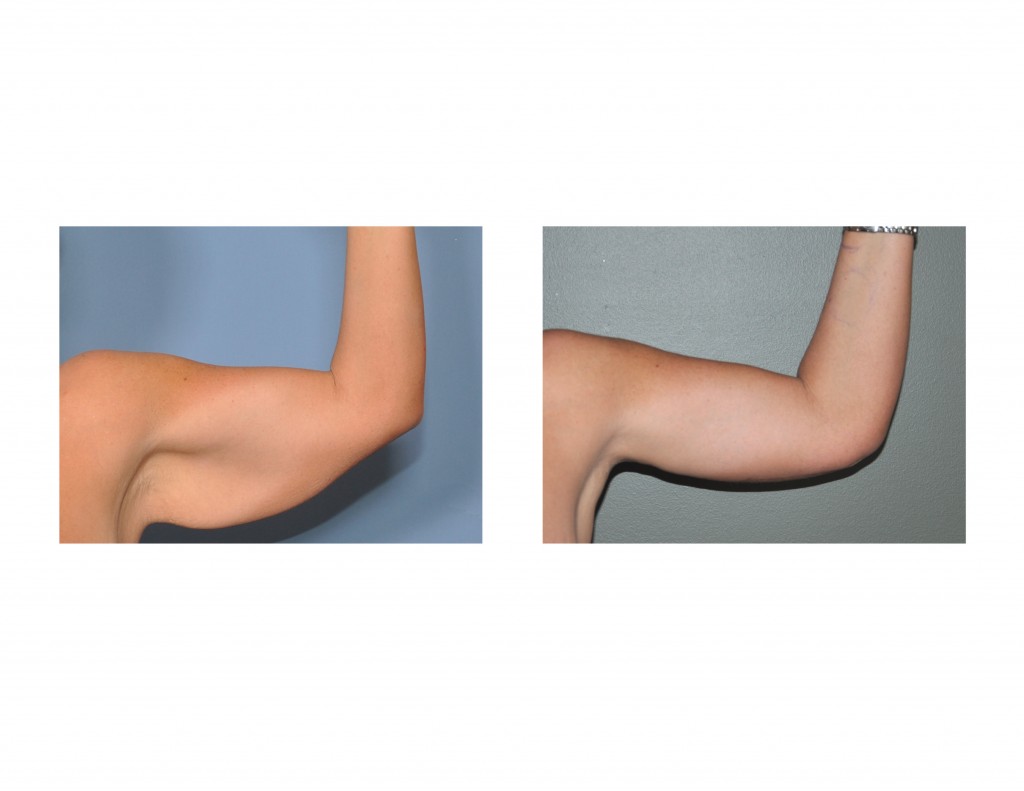 Combining Liposuction and Arm Lifts The Brachiolipoplasty Procedure Explore Plastic Surgery