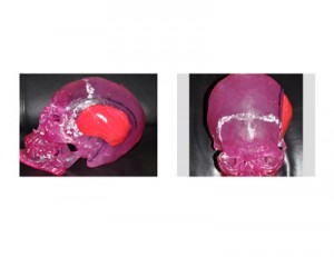 Custom Temporal Implants for Head Widening Dr Barry Eppley Indianapolis