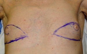 Gynecomastia Reduction with Nipple Transposition markings Dr Barry Eppley Indianapolis