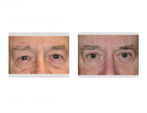 Older Male Eyelid Lift Results front view Dr Barry Eppley Indianapolis