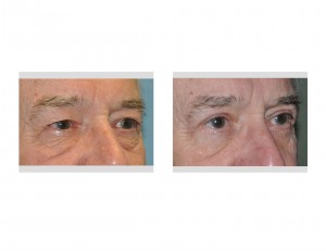 Older Male Eyelid Lift results oblique view Dr Barry Eppley