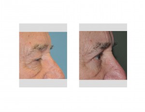 Older Male Eyelid Lift results side view Dr Barry Eppley Indianapolis