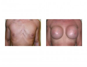 Petite Body Builder Breast Augmentation result front view Dr Barry Eppley Indianapolis