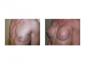 Petite BodyBuilder Breast Augmentation result left oblique view