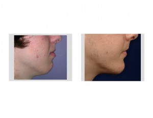 Sliding Genioplasty result side view Dr Barry Eppley Indianapolis
