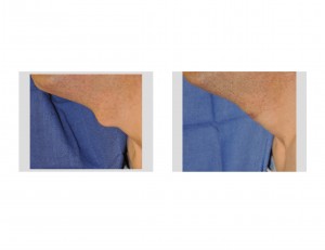 Tracheal Reduction Indianapolis Dr Barry Eppley