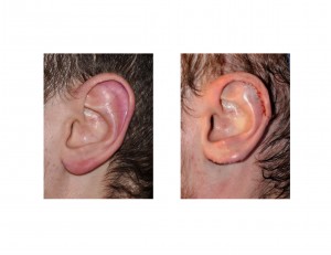 Vertical Ear Reduction Dr Barry Eppley Indianapolis