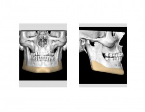 Vertical Lengthening Jawline Implant Design Dr Barry Eppley Indianapolis