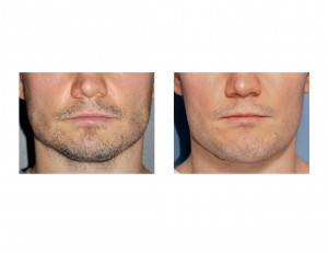 Vertical Lengthening Jawline Implant result front view