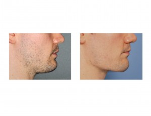 Vertical Lengthening Jawline Implant result side view