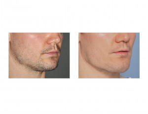 Vertical Lengthenng Jawline Implant result oblique view