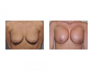 Breast Augmentation without Lift result front view