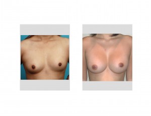 Correction of Breast Asymmetry with Implants Dr Barry Eppley Indianapolis front view