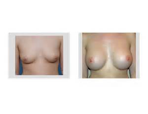 Indianapolis Transaxillary Breast Augmentation Dr Barry Eppley