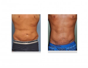 Male Weight Loss Tummy Tuck result front view Dr Barry Eppley Indianapolis