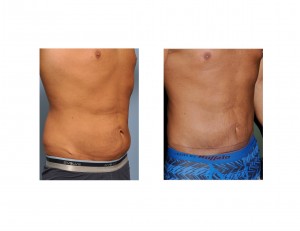 Male Weight Loss Tummy Tuck result oblique view