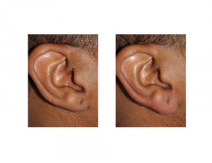 Earlobe Lengthening by Injection Dr Barry Eppley Indianapolis right side