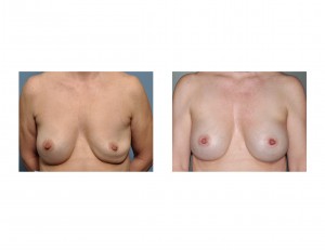 Saline Breast Implant Replacements for Deflation
