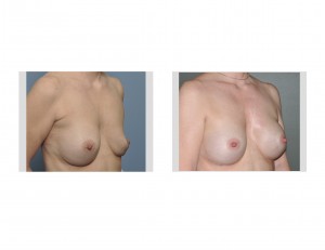 Saline Breast Implant Replacements for Deflation oblique view Dr Barry Eppley Indianapolis